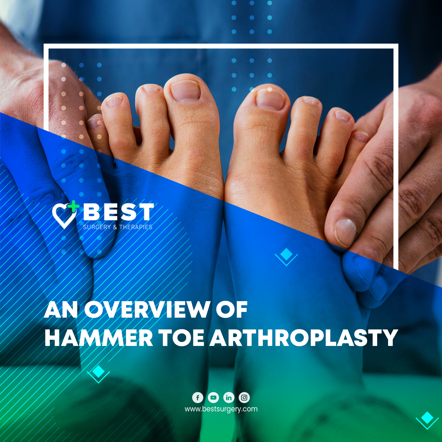 An Overview of Hammer Toe Arthroplasty