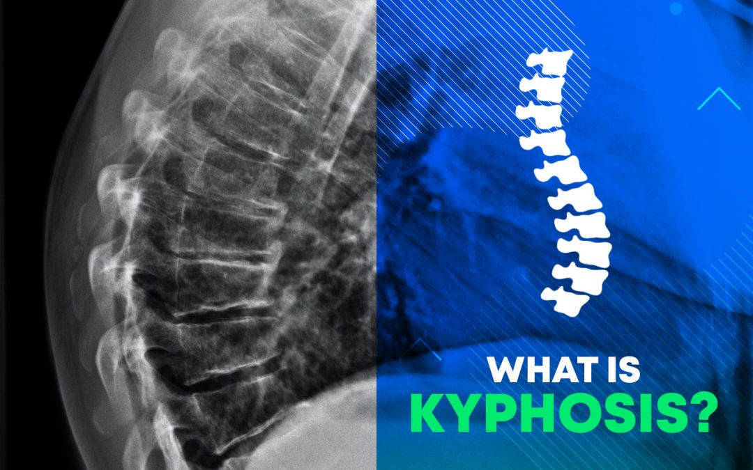 Qu'est-ce que la cyphose?