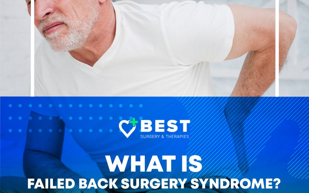 ¿Qué es el síndrome de cirugía de espalda fallida?